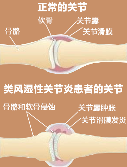 为什么说类风湿性关节炎是‘不死的癌症’？原来真相是这样的