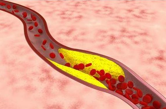 血管一堵百病生！高能负氧离子是血管清道夫！